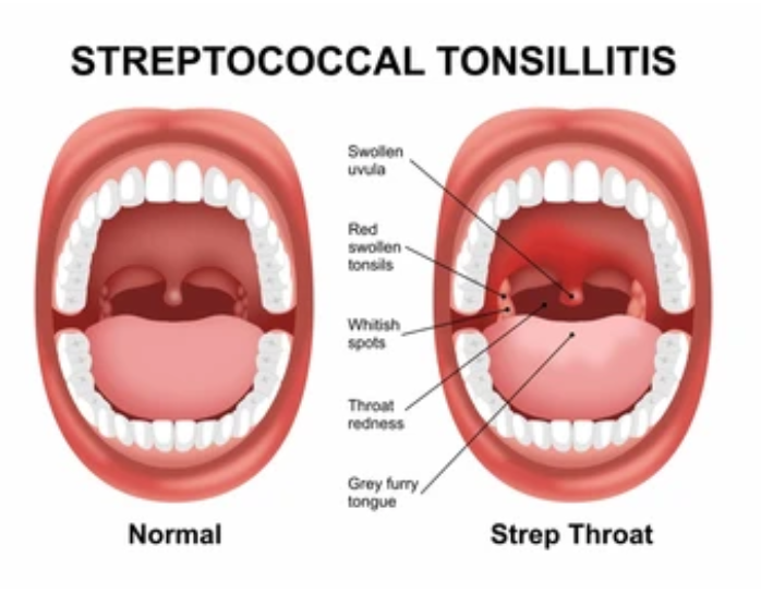 5 Common Strep Throat Symptoms to Know